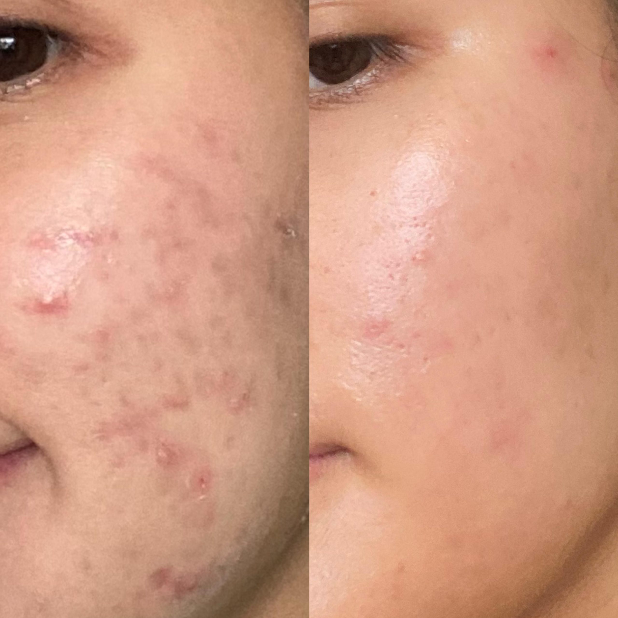 1 Month On Epiduo Vs 6 Months On Epiduo_ Still Not Clear But I'm Getting There!