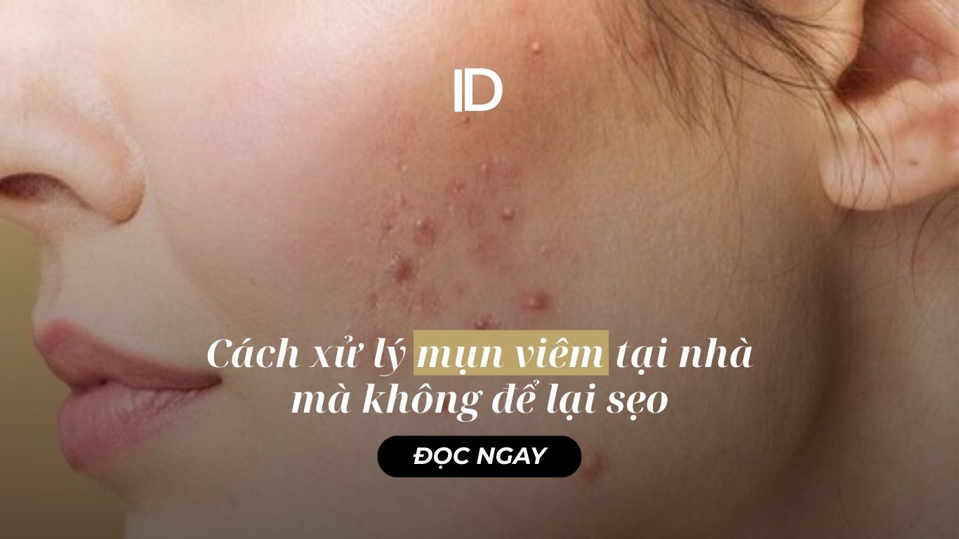 CÁCH XỬ LÝ MỤN VIÊM TẠI NHÀ MÀ KHÔNG ĐỂ LẠI SẸO