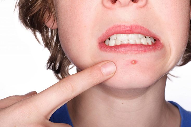 Mụn bọc mọc trên mặt là nỗi ám ảnh với nhiều người