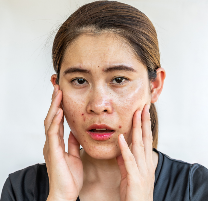 Da dễ bóng dầu và nổi mụn vào ngày hè.