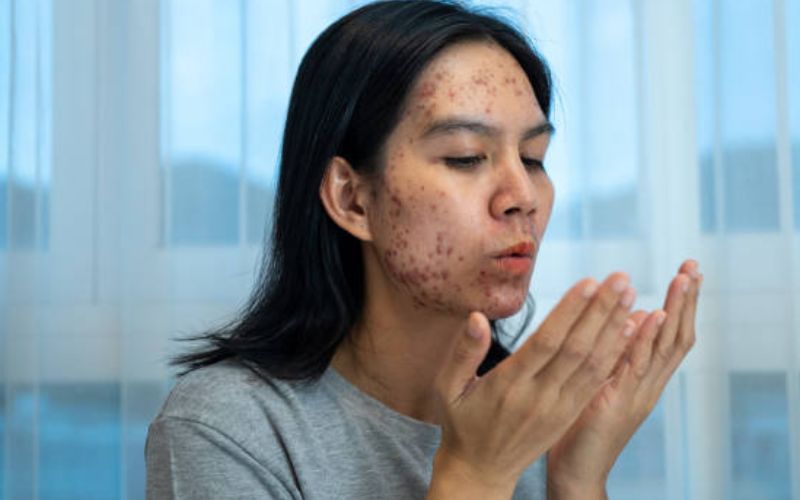 Tình trạng da cần được nghỉ ngơi không tẩy tế bào chết