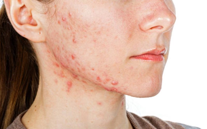 Tình trạng da báo hiệu đang bị kích ứng