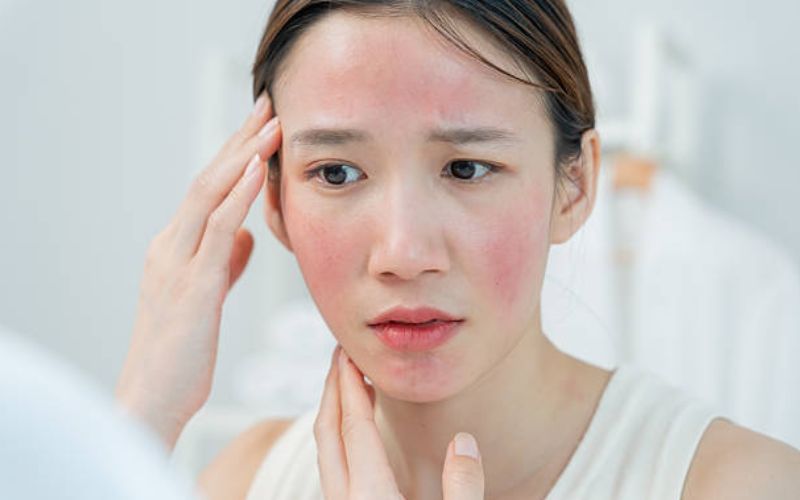 Tình trạng da mẩn đỏ khi tẩy quá mức và sai cách