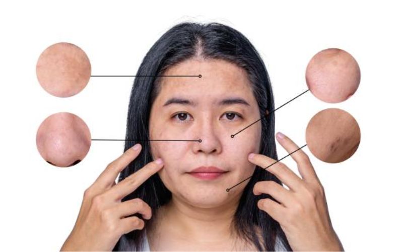 Bí tắc da gây thâm nám