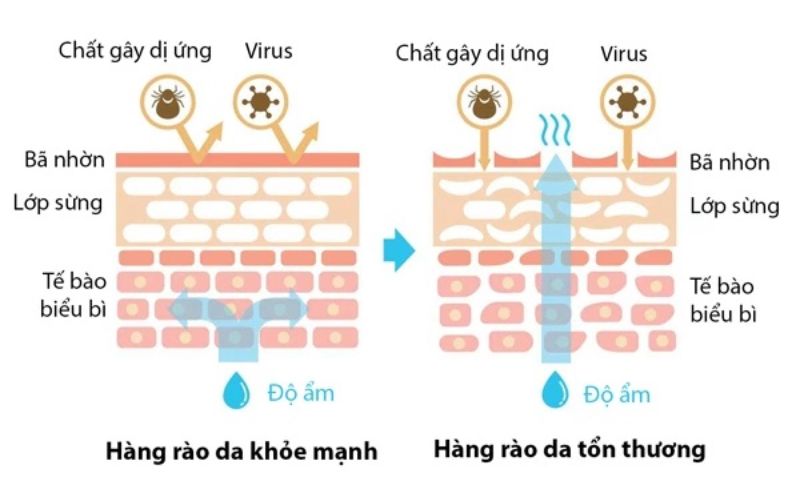 Rối loạn hàng rào bảo vệ da
